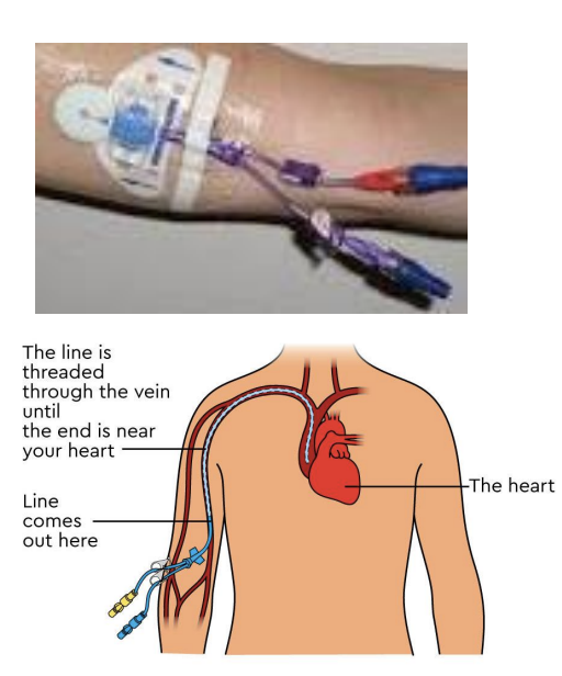 <p>Line</p><p>Purpose: long term IV access (meds, nutrition)</p><p>(located in upper arm but considered a CVC)</p>