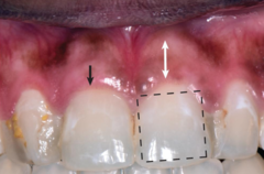 <p>thick flat biotype</p>