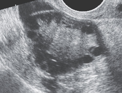 <p>1. The 24-year-old patient in Figure 21-25 presented with hirsutism and obesity. What is the most likely clinical diagnosis based on these sonographic findings?</p><p>a. Asherman syndrome</p><p>b. PCOS</p><p>c. Endometriosis</p><p>d. Fitz-Hugh–Curtis syndrome</p><p></p>