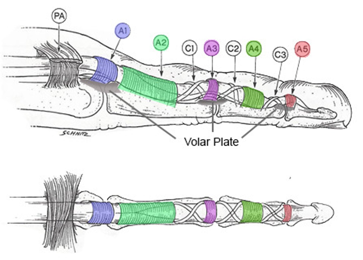 <p>Band of tissue holding flexor tendon closely to finger bones, near palm</p><p>- responsible for trigger finger</p>