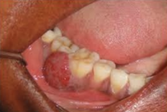 <p>your female patient who is 33 years old comes for her 6 month appointment. you notice some abnormalities on the interdental gingiva. she confirms that she is not taking any medication other than tylenol for headaches. the abnormalities could be related to:</p><p>a. pregnancy </p><p>b. calcium channel blockers </p><p>c. lack of homecare </p><p>d. smoking</p>