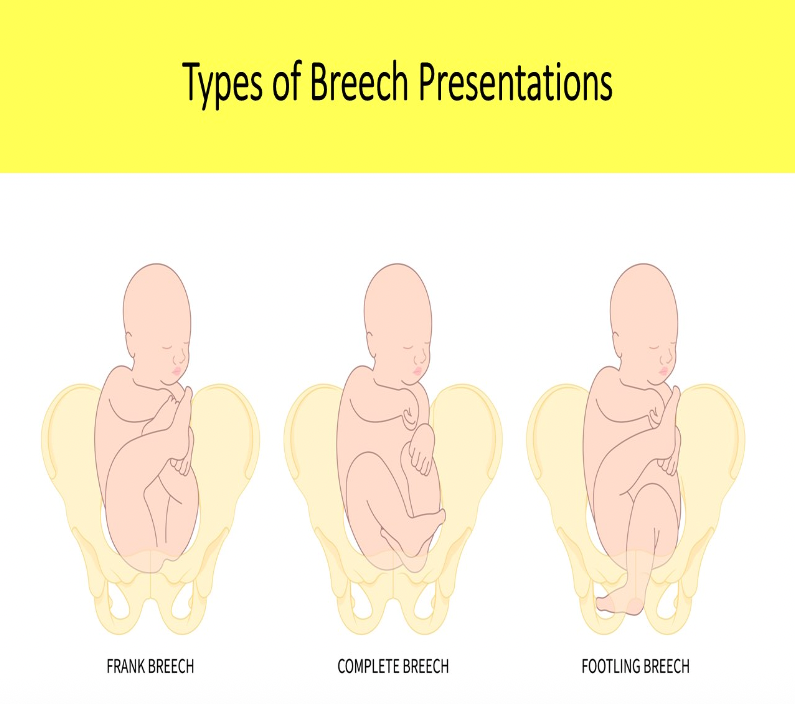 <p>A. Footling</p><p>Frank breech = butt down legs straight up in front of abdomen</p><p class="p1">Complete breech = butt down legs folded, knees bent, ankles crossed</p><p class="p1">Footling breech = feet down, baby "standing" on cervix</p>