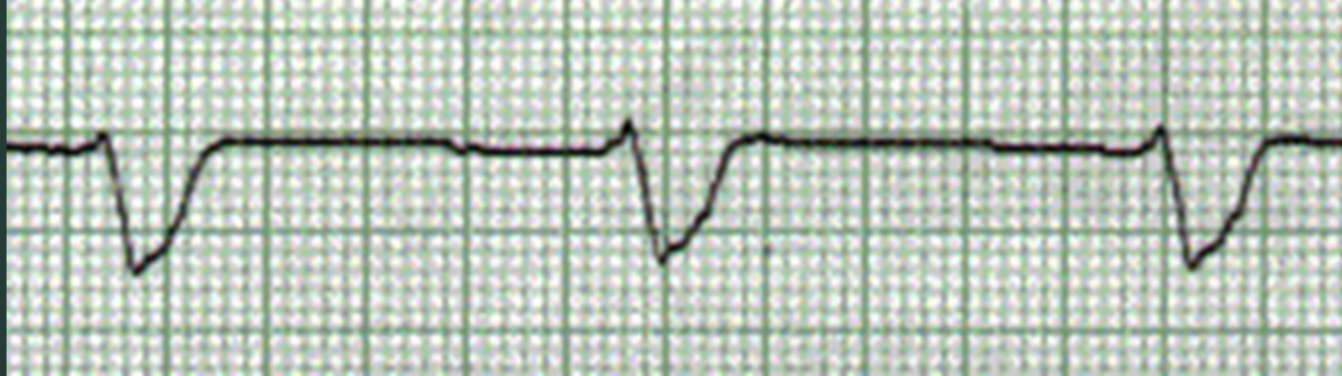 <p>What’s characteristic of a ventricular escape rhythm?</p>