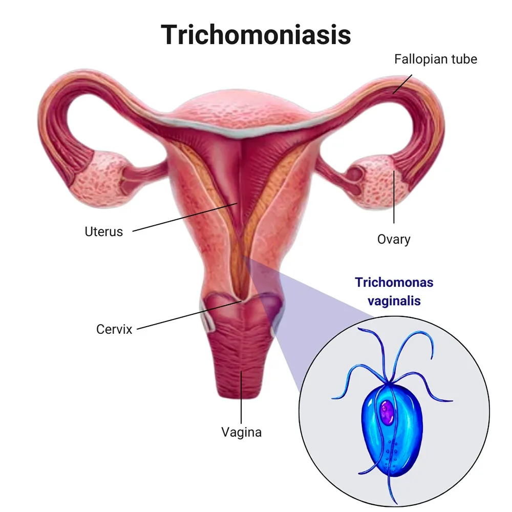 <p>Trichomoniasis</p>