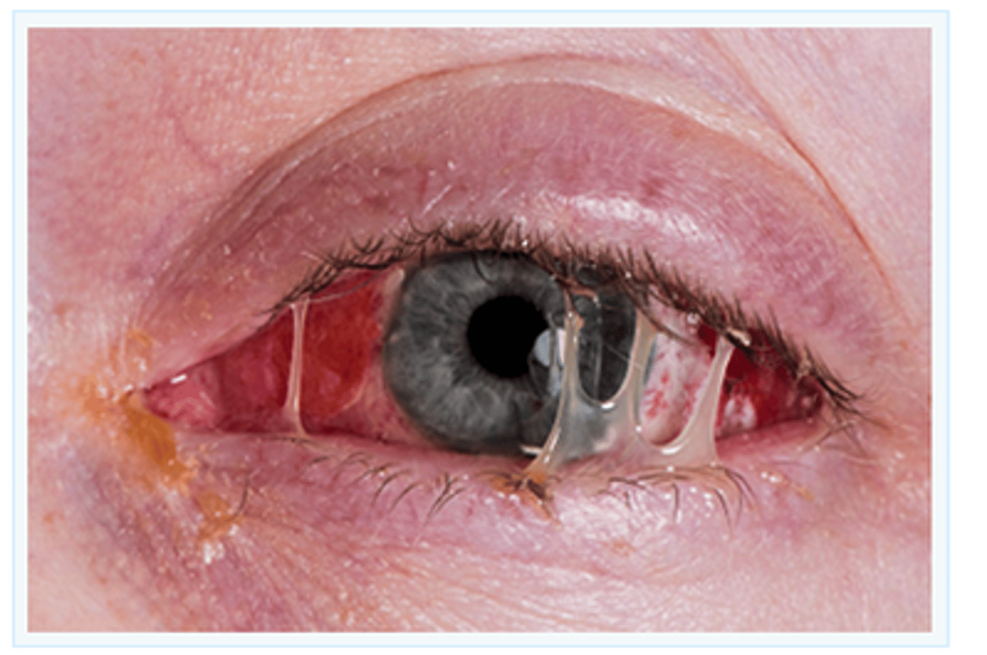 <p>Infection of the outer lining of the eye, known as the conjunctiva</p>