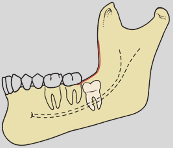 <p>the occlusal plane of the impacted tooth is below the cervical line of the second molar</p>