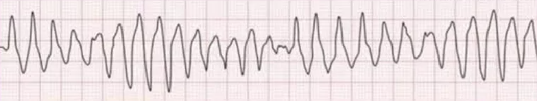 <p>the image shown depicts what cardiac arrhythmia?</p>