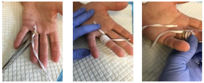 <p>Exsanguinate finger with tourniquet </p><p>Insert tape with hemostat </p><p>Wind tape proximal to distal </p><p>Pull proximal edge to unwind</p>