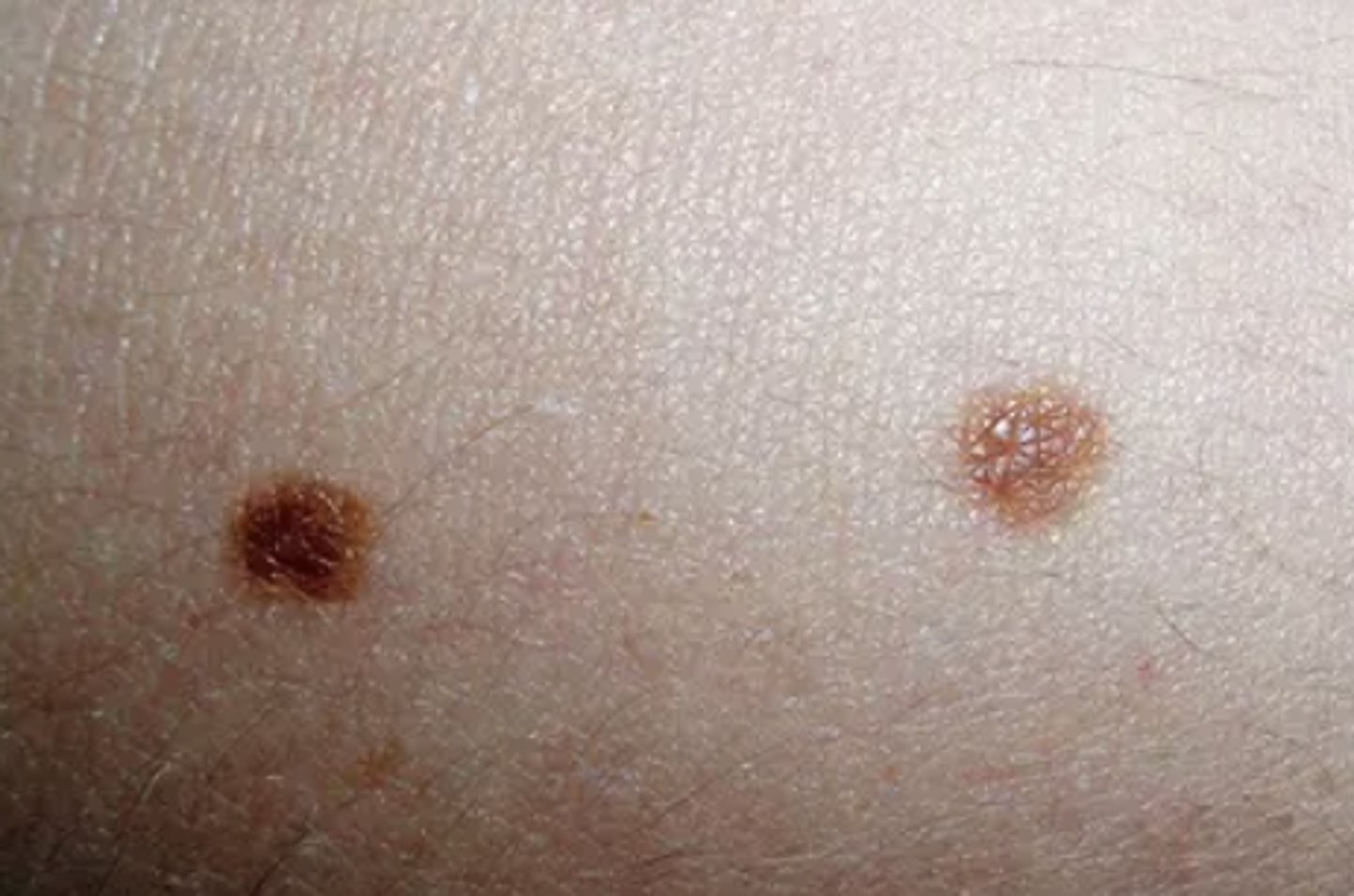 <p>a flat non raised skin or mucosal lesion (less than 1cm in size)</p>