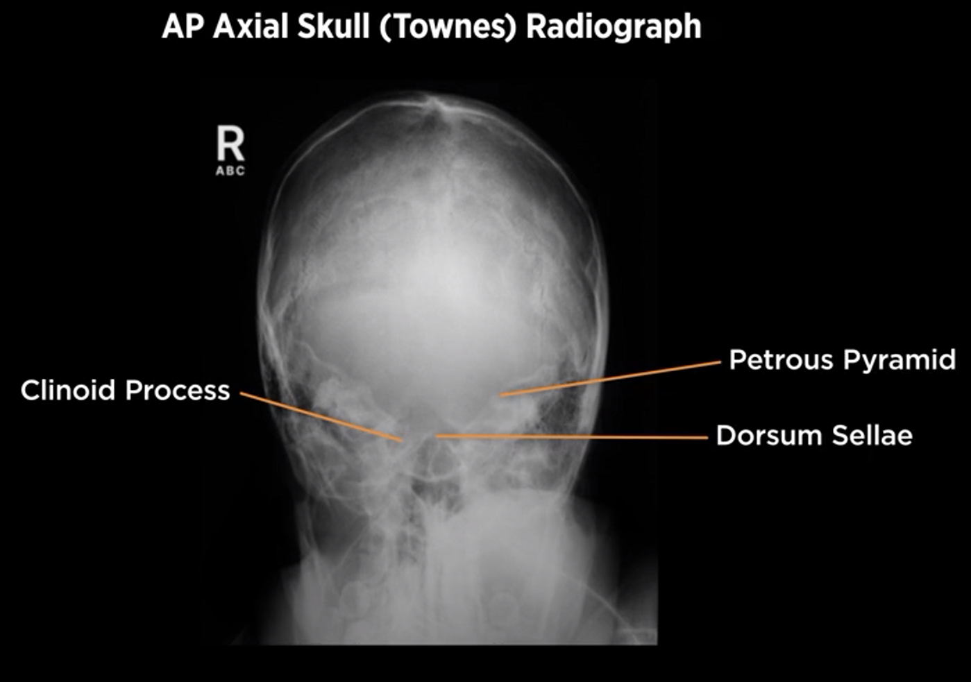 <p>AP Axial Skull (Townes)</p>