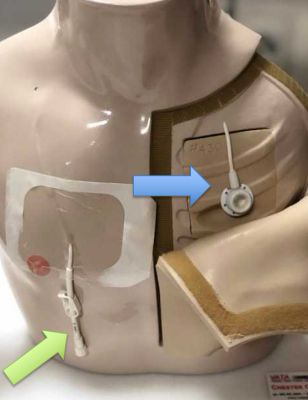 <p>How do these&nbsp;<strong>vascular access ports</strong>&nbsp;differ?</p>