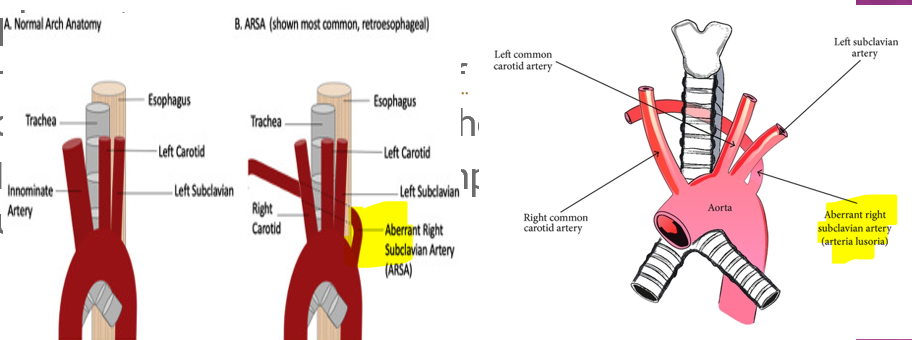 <p>rare anomaly in which right subclavian artery arises directly from ao arch instead of originating from the brachiocephalic artery </p>