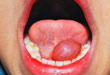 <p>mucous retention cyst on the floor of the mouth</p>
