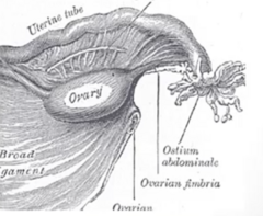<p>- Non-functional → failure to menstruate → infertile</p><p>- "Streak Ovaries" Fibrous connective tissue in location of ovaries, very few follicles</p>
