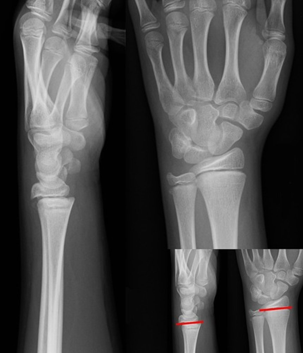 <p>fracture through physeal plate only</p><p>*may be hard to visualize, look for misalignment b/w epiphysis & metaphysis</p>