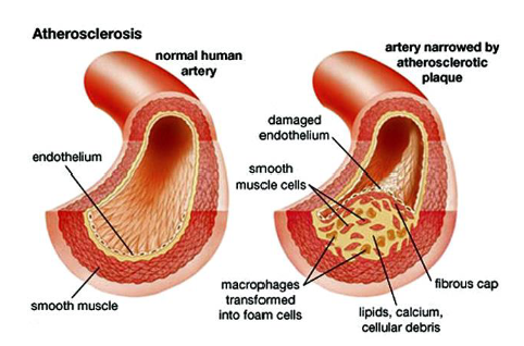 <p>Chronic inflammatory disease, caused by the formation of ‘fibro-fatty’ lesions in the arterial wall</p>