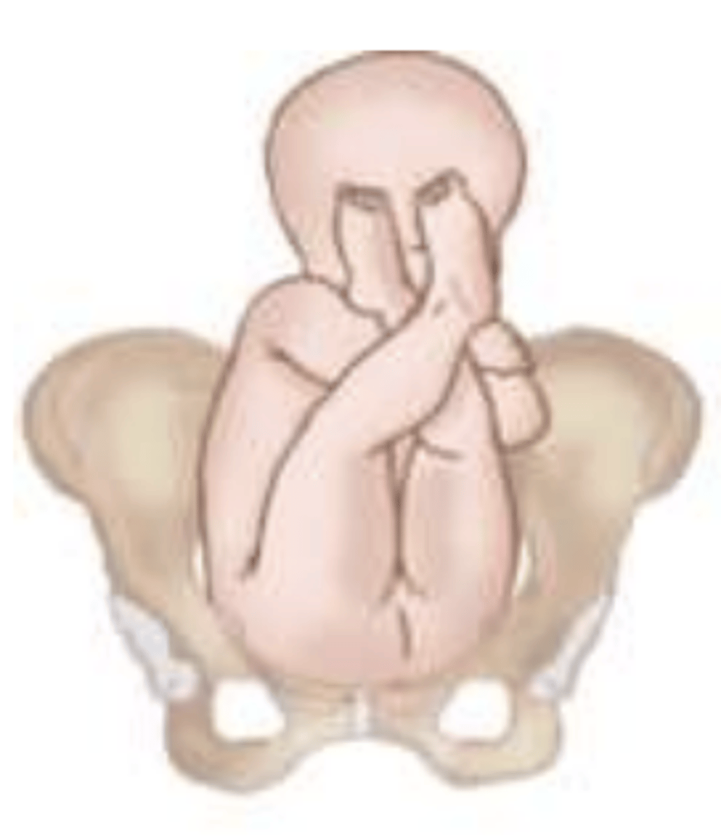 <p>most common type with hips flexed, knees extended, and feet adjacent to head</p>