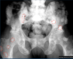 <p>What form of Mets is this?</p><p>- Multiple Snowball appearance</p><p>- Male: Prostate</p><p>- Female: Breast</p>
