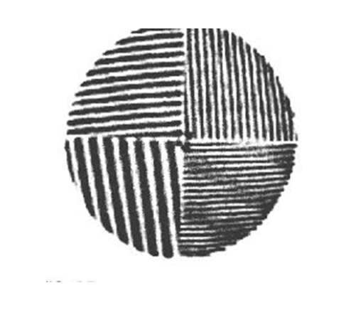 <p>What is the depicted abnormality?</p>