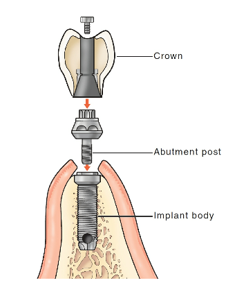 <p>implant, abutment, crown</p>
