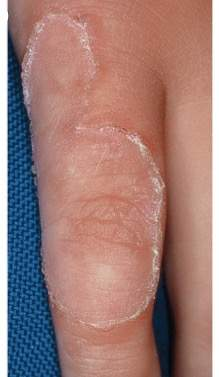 <p><span style="line-height: inherit; font-size: inherit;">Large plaque arising in infancy or childhood on distal extremities, several centimeters in diameter</span></p><p><span style="line-height: inherit; font-size: inherit;">this is what</span></p>