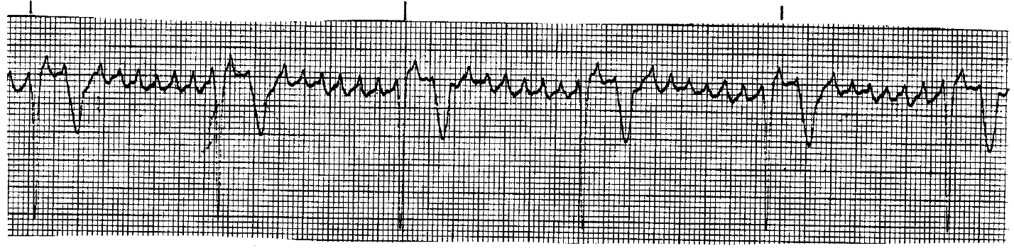 <p>What ECG is this? </p>