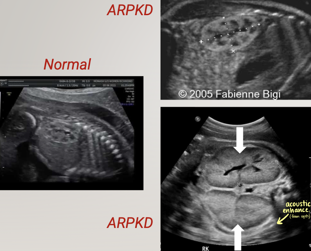 <p>ARPKD (autosomal recessive polycystic kidney disease)</p>