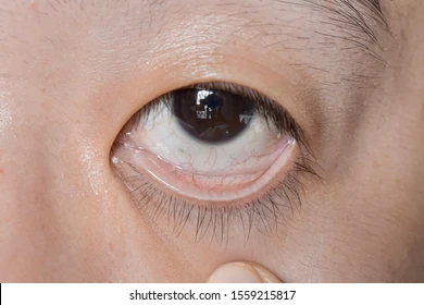 <p>Pale skin</p><p>Anemia, decrease in RBC circulation, decrease in blood flow, absence of oxygenated blood</p>