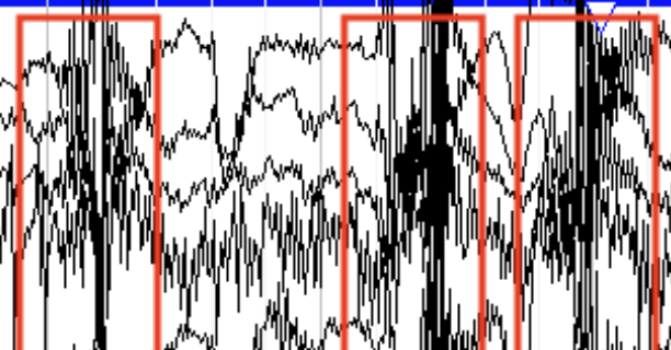<p>Intermittent bursts, </p>