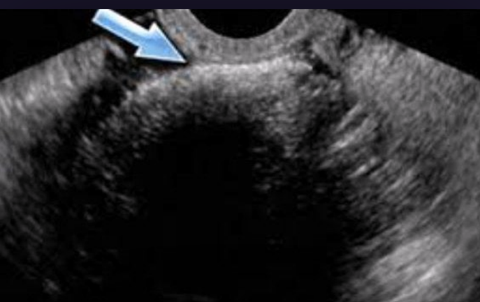 <p>Which benign mass is associated w/ the tip of the iceberg sign?</p><p>a. Mucinous adenocarcinoma</p><p>b. Dysgerminoma</p><p>c. Corpus luteum cyst</p><p>d. Mature teratoma (dermoid)</p>