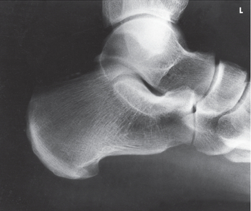<p>Which tarsal is in profile?</p>