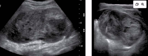 <ul><li><p><span style="background-color: transparent;">Malignant tumor of abdominal wall</span></p></li><li><p><span style="background-color: transparent;">Types:&nbsp;liposarcoma, rhabdomyosarcoma, fibrosarcoma</span></p></li><li><p><span style="background-color: transparent;">Limited clinical symptoms → very large upon discovery</span></p></li><li><p><span style="background-color: transparent;">Ultrasound appearance:&nbsp;</span></p><ul><li><p><span style="background-color: transparent;">Hypoechoic or isoechoic to muscle</span></p></li><li><p><span style="background-color: transparent;">Heterogeneous</span></p></li></ul></li></ul><p></p>