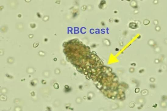 <p><strong>Red Blood Cell (RBC) casts</strong> (indicates bleeding within the nephron).</p>