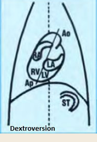 <p>Dextroversion</p>