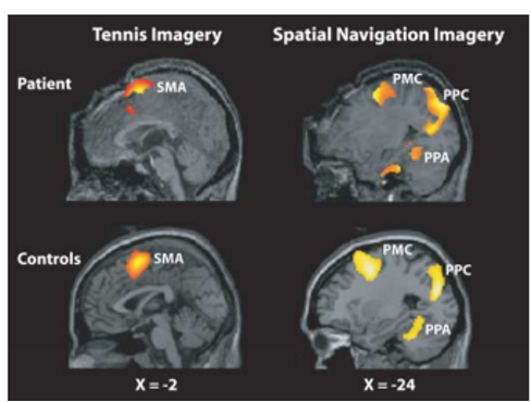 <p><span style="background-color: transparent;">Owen et al. (2006) fMRI with people in Persistent Vegetive states, in deep comas, appear not conscious at all, is there any conscious awareness&nbsp;</span></p><ul><li><p><span style="background-color: transparent;">Asked participants to either imagine playing tennis (activates a reliable pattern of activation - SMA activates), or imagine walking around house counting windows (reliable activation that is dif to playing tennis) to indicate yes or no&nbsp;</span></p></li><li><p><span style="background-color: transparent;">Small percentage were able to do the task and answer questions&nbsp;</span></p></li></ul><p></p>