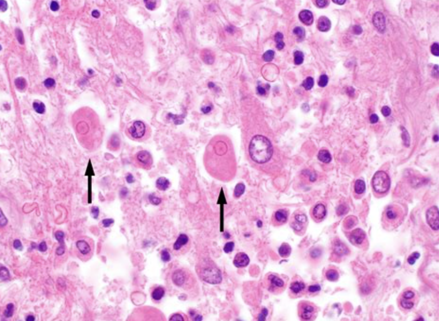 <p>Patient avec colite </p><p>1) diagnostic </p><p>2) histologie </p>
