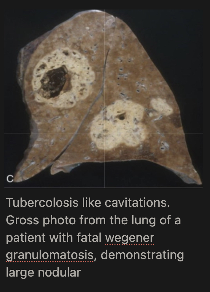<p>What happens to lung granulomas in Wegener's GPA?</p>