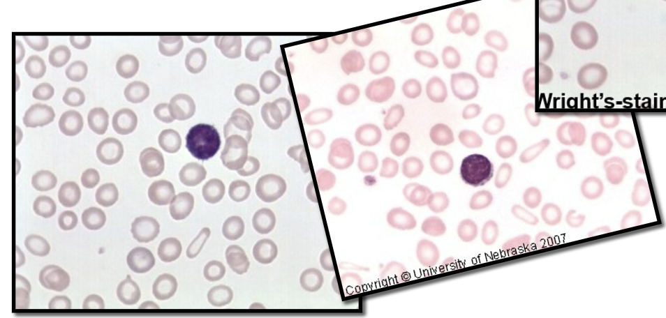 <p><strong>Smear Findings</strong></p><ul><li><p>mild to severe microcytic/hypochromic</p></li><li><p>ovalocytes/pencils</p></li><li><p>NO RBC INCLCUSIONS</p></li></ul><p><strong>MCV</strong></p><ul><li><p><82.0</p></li></ul><p></p>