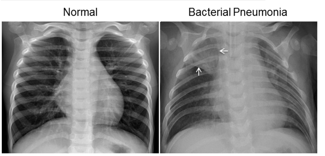 <p><span>generally more severe and include things like bronchitis and pneumonia. </span></p><ul><li><p><span>Inflammation and the presence of pathogens in the lungs can cause the airways to narrow and the alveoli to fill with pus and fluid instead of air. </span></p></li><li><p><span>On an x-ray, air is completely black whereas the pus and fluid can appear as a hazy white:</span></p></li></ul><p></p>