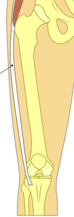<p>Fascia running from the iliac crest to the lateral tibia.</p>