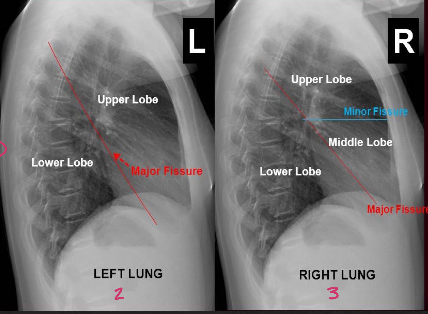 <p>major (oblique) and minor (horizontal) fissures should be pencil thin or not visible</p>
