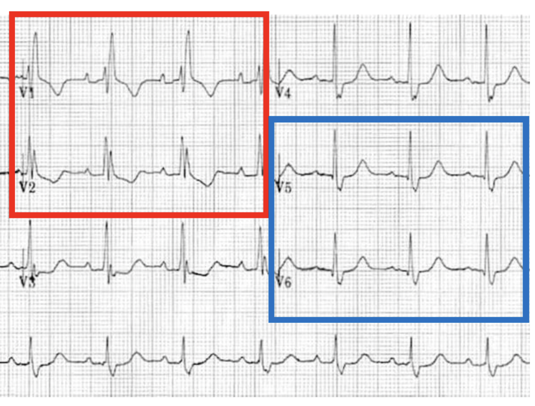 <ul><li><p><span><strong>RSR’ pattern on the right side of the heart → V1 &amp; V2 shows a conduction delay</strong> </span><span style="background-color: transparent;">→ “bunny ears”</span></p></li><li><p><span><strong>Reciprocal Deep S on left side of the heart → V5 &amp; V6</strong></span><span style="background-color: transparent;">→ “slurred S”</span></p></li></ul><p></p>