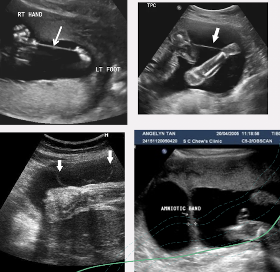 <ul><li><p><span style="color: red;">echogenic bands within amniotic cavity </span></p><ul><li><p>follow band from uterine wall to fetal attachment</p></li><li><p>if bands are small, may not be able to visualize</p></li></ul></li><li><p>any missing extremities or facial deformities should raise suspicion of ABS</p></li><li><p>document normal appearance of extremities and fetal contour</p><ul><li><p>help to rule out ABS</p></li></ul></li></ul><p></p>