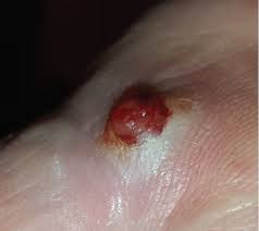 <p>pyogenic granuloma</p>