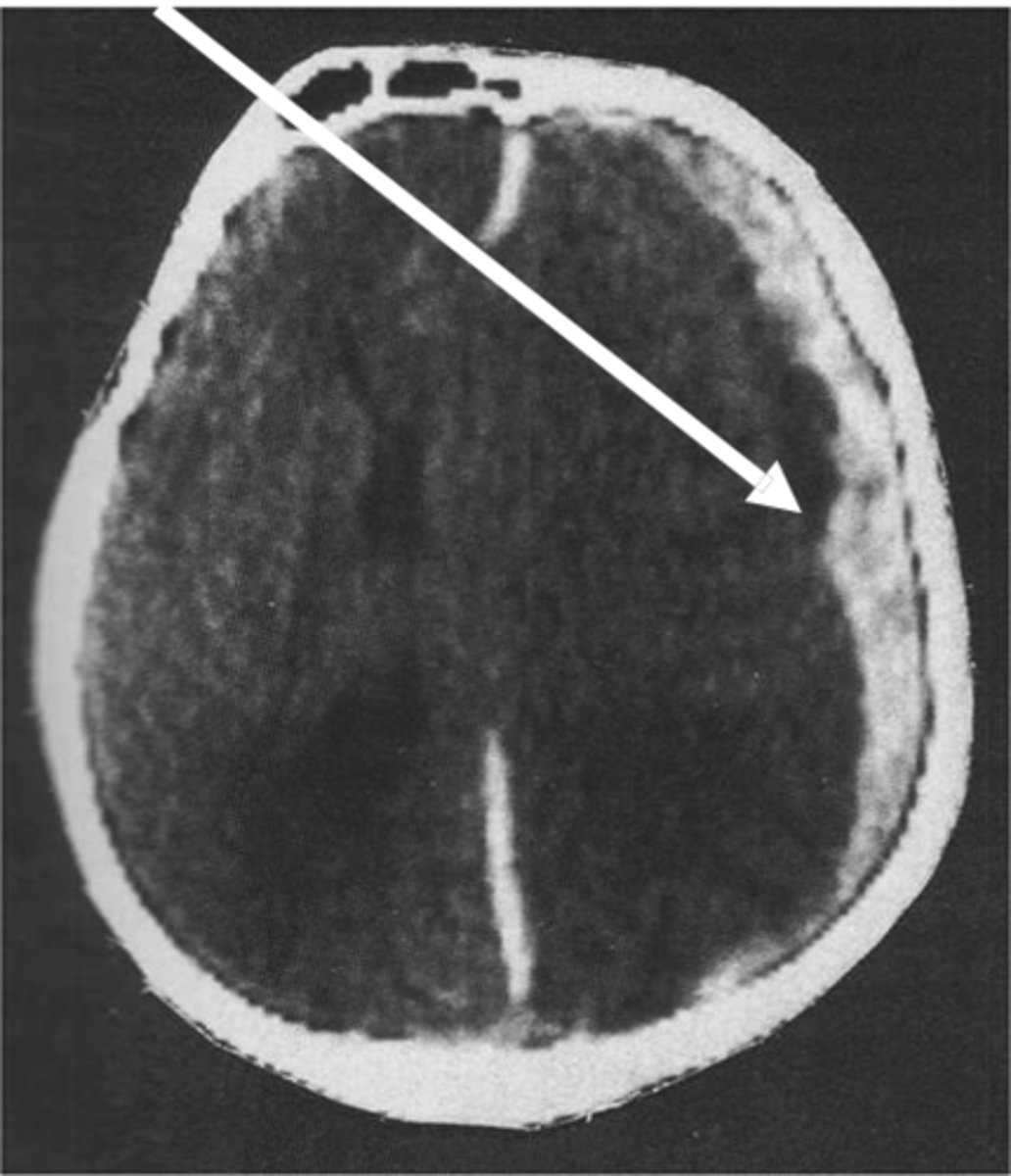 <p>located b/w dura & arachnoid</p><p>cross suture</p><p>CANNOT cross midline, confined to cerebral hemispheres</p><p>common cause: trauma, elderly, child abuse</p>