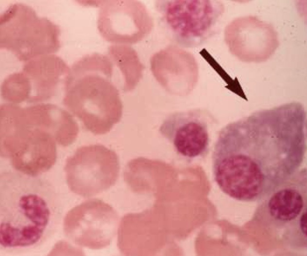 <p>Chronicity of fluid sample</p>