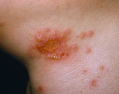 <p>A skin infection caused by the herpes simplex type 1 virus and seen among athletes participating in contact sports</p>