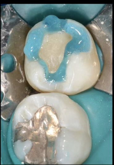 <p>37% phosphoric acid: enamel 30 sec </p>