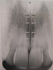 <p>median palatine suture</p>