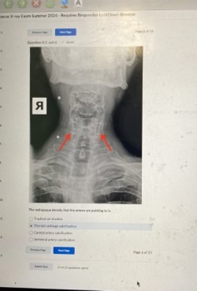 <p>thyroid cartilage calcification</p>